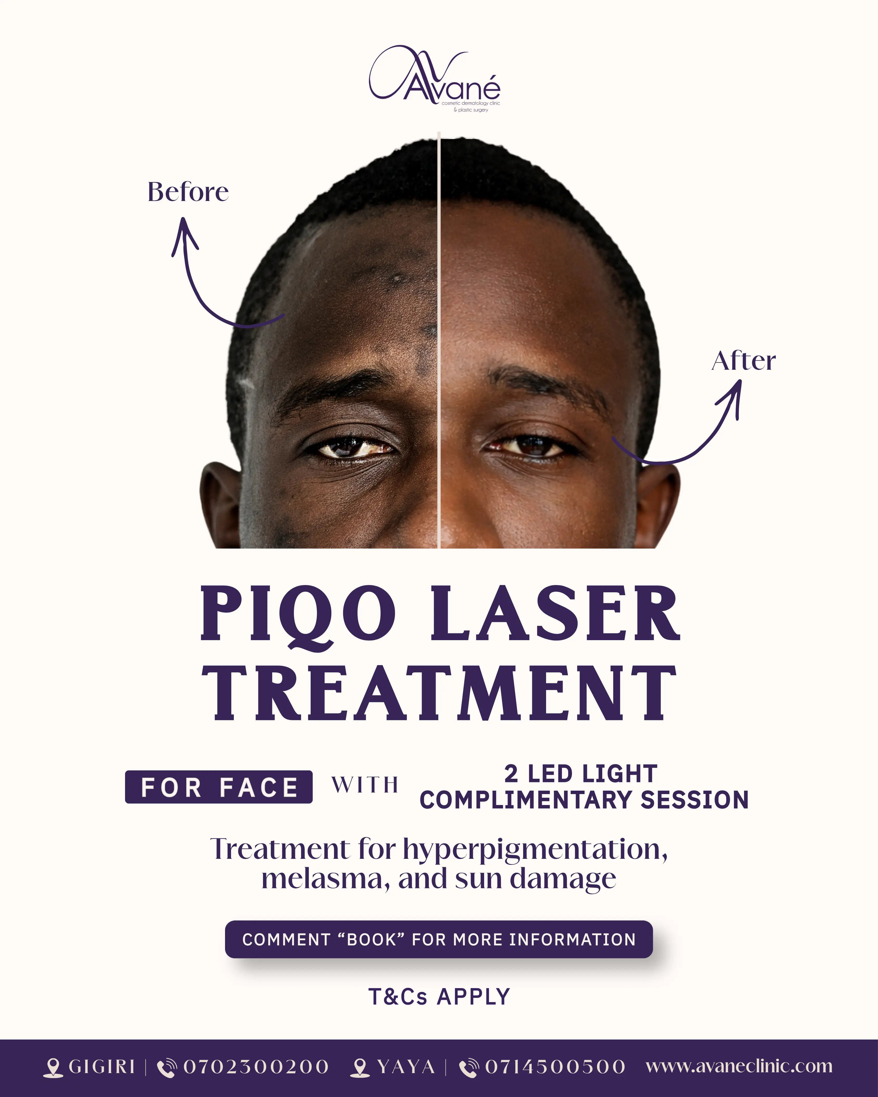PIQO laser April offer